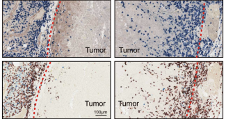 Researchers found a mechanism by which cancers keep T cells from infiltrating tumors. In areas of a tumor with low levels of a molecule called HRS with a phosphate group added, T cells could penetrate (right panels), but they were nearly blocked in areas with high levels of phosphorylated HRS (left panels).