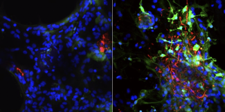 In mouse neurons deficient in the membrane protein TMEM175 (right panel), researchers found damage to lysosomes (green) and a build-up of alpha-synuclein (red), clumps of which are implicated in Parkinson’s disease pathology. (Image: Courtesy of the Ren laboratory)